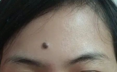 文章标题-8 面部常见痣相的吉凶意义!