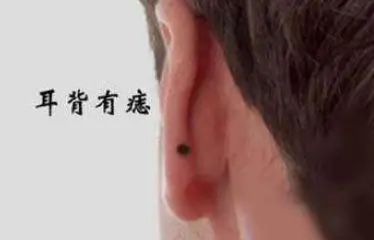 文章标题-15 面部常见痣相的吉凶意义!